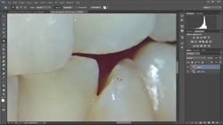 Избелване на зъби - Част 1